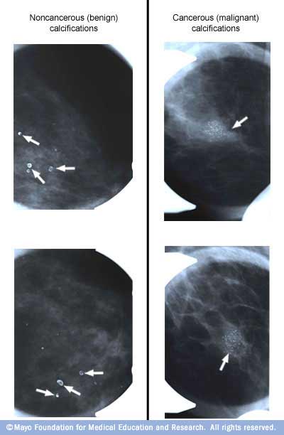 Mammograms With Cancer