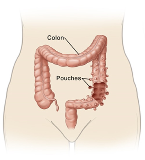 These natural remedies will treat Diverticulitis (Diverticulosis) completely.