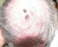 skin cancer on the scalp