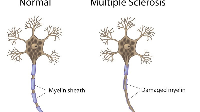 Management Of Multiple Sclerosis - How Is Multiple Sclerosis Treated