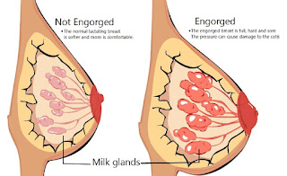 Dealing with Engorged Breasts after Birth