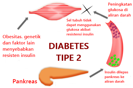 Berbagai Penyebab Diabetes Tipe 2 Diabet-Medicine.blogspot.com