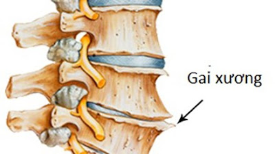 Tìm hiểu gai xương là bệnh gì?