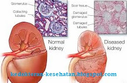 jenis penyakit ginjal dan penyebabnya