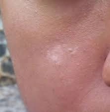 sebaceous filaments. The tip of a woman's face in it sebaceous filaments