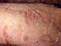 obat kutil kelamin atau kutil di kemaluan natural paling mujarab