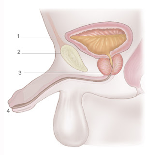 uretritis