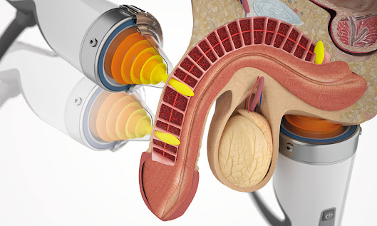 Erectile Dysfunction Treatment in Dubai