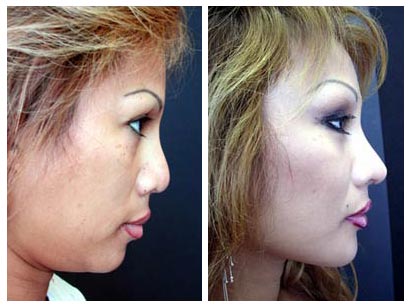 Chin Implants Before And After