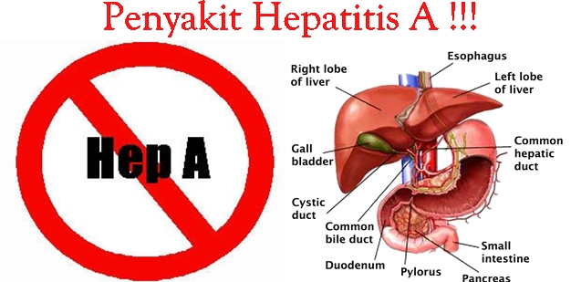 Obat Tradisional Hepatitis A