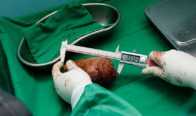 World’s largest kidney stone removed – and it’s the size of a grapefruit
