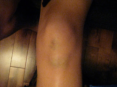 bruised  knee