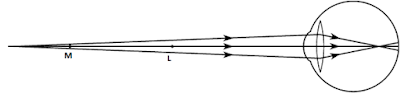 Myopia defect 2