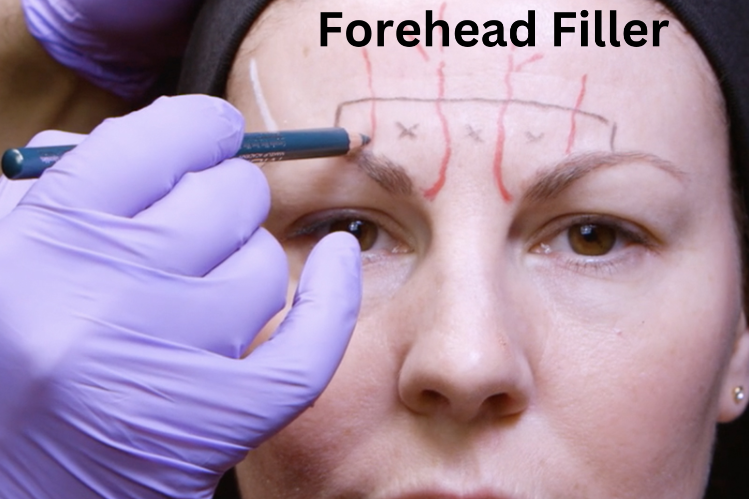 Forehead Filler: Achieve Smooth & Natural Results