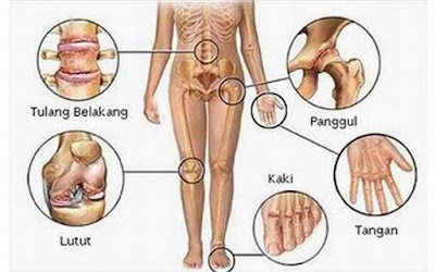 jamu asam urat, jamu tradisional asam urat, obat asam urat, ciri-ciri asam urat,ramuan tradisional asam urat