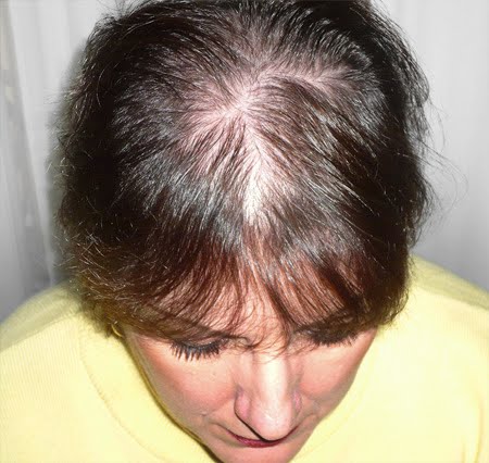 Alopecia Androgenetic on Healthy And Beauty Tips  Alopecia Treatments   Alopecia Remedies