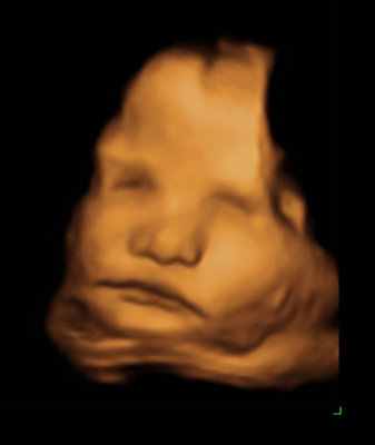 3d Ultrasound Pictures1