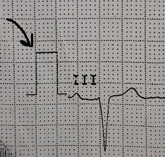 standardisation in ecg