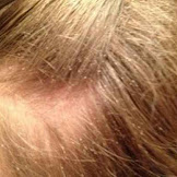 Lice Nits In Blonde Hair