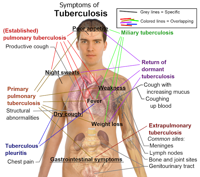 Tanda Dan Gejala  TBC (Tuberkulosis)