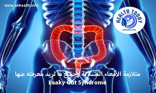 متلازمة الأمعاء المتسربة وجميع ما تريد معرفته عنها Leaky Gut Syndrome