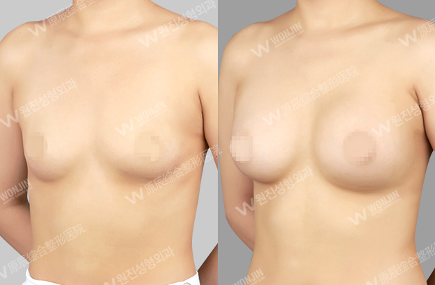 짱이뻐! - Before and After Photos Korean Breast Plastic Surgery