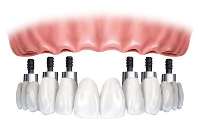 painless implant,implant causes,implant treatment