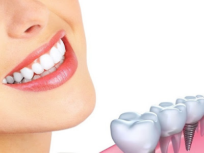Tìm hiểu địa chỉ trồng răng implant tốt nhất ở đâu? 3