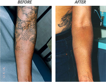 Laser Tattoo Removal Before And After | Laser Tattoo Removal