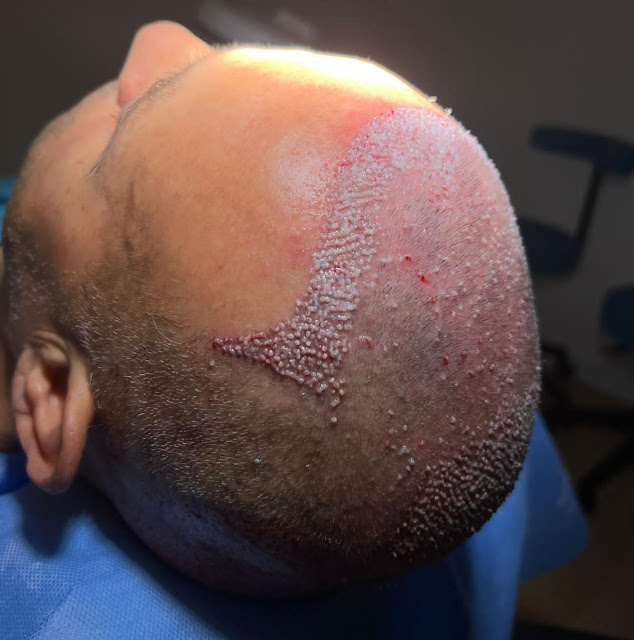 Uomo di 35 anni, dopo trapianto di capelli con metodo DHI in Albania, 2800 innesti