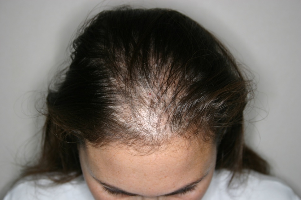 what cause hair loss: Can women hair loss makes me totally bald?