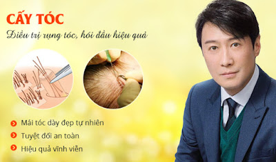 Điều trị hói đầu bằng phương pháp cấy tóc