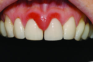 Sưng chân răng không đau là bệnh gì?