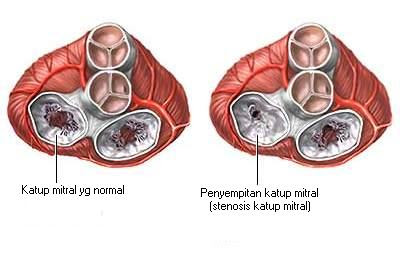 Stenosis katup mitral