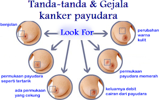 Apa Obat Kanker Payudara Secara Alami, Kanker Payudara Hormon, Jenis Pengobatan Kanker Payudara, Penyembuhan Kanker Payudara Tanpa Operasi, Kanker Payudara Getah Bening, Obat Alami Tuk Kanker Payudara, Obat Herbal Mengatasi Kanker Payudara, Cara Mengobati Kanker Payudara Secara Tradisional, Obat Paling Manjur Untuk Kanker Payudara, Obat Herbal Buat Penyakit Kanker Payudara, Konsultasi Kanker Payudara, Kanker Payudara Yg Sudah Parah, Cara Pengobatan Kanker Payudara Stadium Lanjut, Mengobati Kanker Payudara Stadium Awal, Olahraga Menyembuhkan Kanker Payudara, Tanda Awal Gejala Kanker Payudara, Apa Penyebab Kanker Payudara Pada Pria, Obat Kanker Payudara Yang Alami, Bagaimana Cara Mengobati Kanker Payudara Dengan Daun Sirsak, Kanker Payudara Peraboi, Obat Kanker Payudara Adalah, Obat Kangker Payudara Paling Ampuh, Kanker Payudara Female Daily, Kanker Payudara Ciri2, Gejala Awal Yg Dirasakan Penderita Kanker Payudara, Pengobatan Alternatif Kanker Payudara Di Jakarta, Obat Alami Kanker Payudara Ginjal Dan Parkinson, Obat Kanker Payudara Yg Ampuh, Penyebab Kanker Payudara Laki-Laki, Kanker Payudara Pada Lansia, Herbal Mengobati Kanker Payudara, Obat Alami Sakit Kanker Payudara, Obat Tradisional Untuk Kanker Payudara 