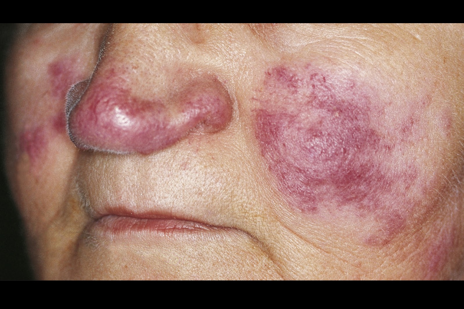 Download this Lupus Symptoms And... picture