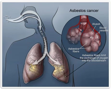 Mesothelioma diagram