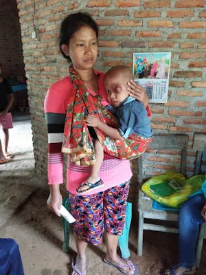 Anak Pengidap Kanker Mata Ganas Ini Membutuhkan Uluran Tangan Para Dermawan