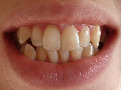 A front on photo of crooked teeth before orthodontic treatment with mouth closed