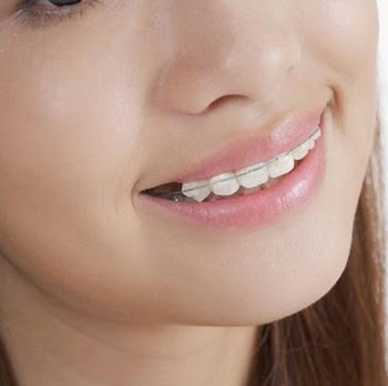 Niềng răng cho trường hợp hô nào?
