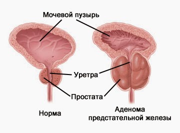  размеры аденомы предстательной железы