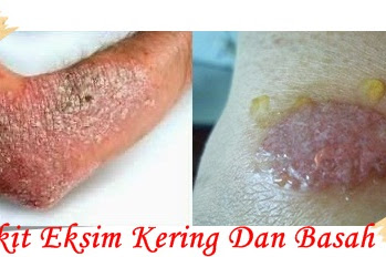 Waspadai Penyakit Eksim