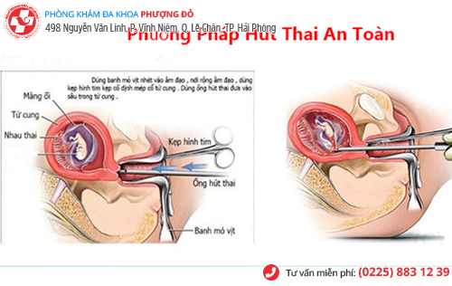 hút thai chân không