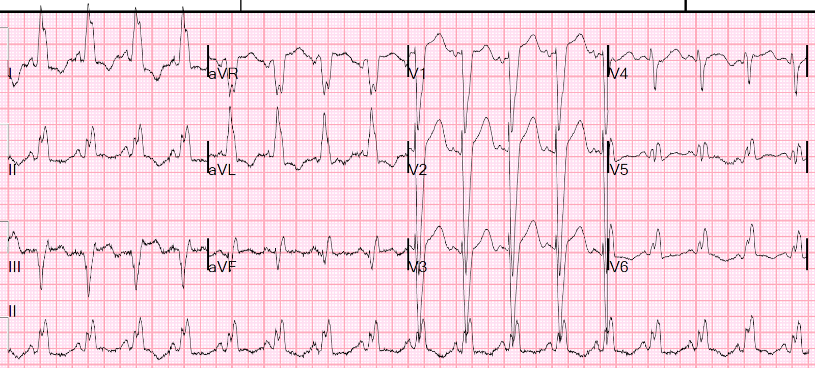 Dr Smith S Ecg Blog Wide Complex Tachycardia With Fusion And Capture Beats Not What You Think