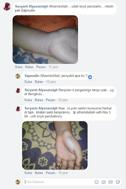 Cara Menghilangkan Benjolan Di Tangan