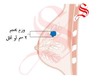 ما لا تعرفه عن سرطان الثدي (Cancer Breast)