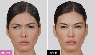 Botox treatment Los Angeles