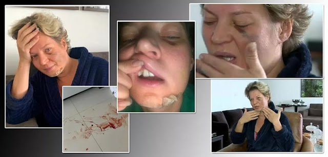 VÍDEO: Joice Hasselmann acorda com fraturas no corpo, diz não se lembrar do que houve e suspeita de atentado