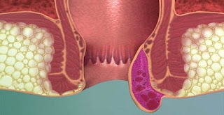 تعرف على شكل البواسير الخارجية  بالصور الحقيقية 