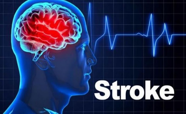 Solusi pengobatan stroke sudah 10 th dengan Konsep Karnus